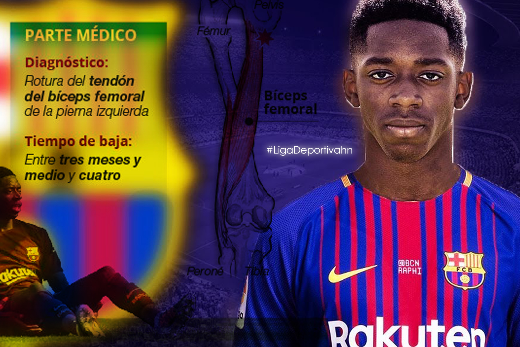 Ousmane Dembélé estará 4 meses de baja tras exitosa operación 